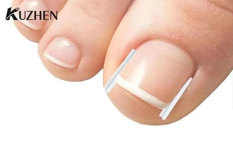 50Pc Ingrown Toenail Correction Treatment